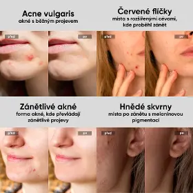Přístroj na čistení pleti - Jovs JA3 Acneaway přístroj na léčbu akné - 2